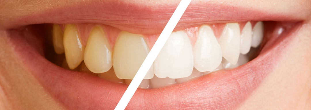 Ästhetische Zahnheilkunde - Zahnarztpraxis Dr. Matthias Borho Karlsruhe Durlach - Slider Bild