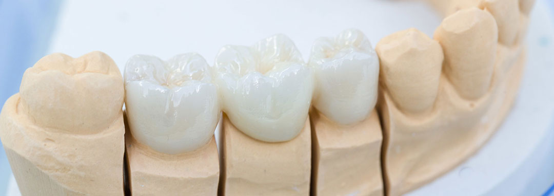 Zahnersatz Implantologie - Zahnarztpraxis Dr. Matthias Borho Karlsruhe Durlach - Slider Bild