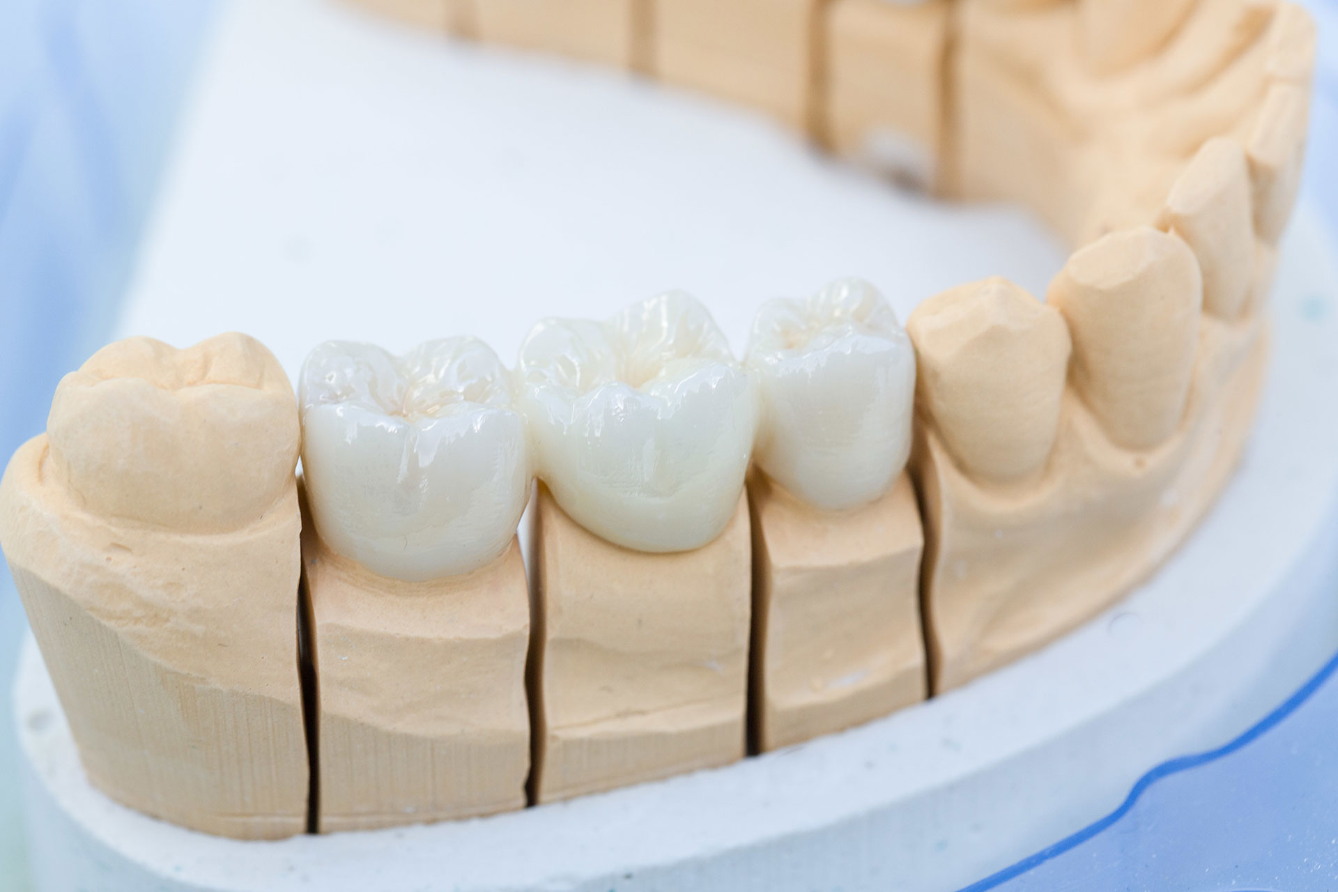 Zahnersatz Implantologie - Zahnarztpraxis Dr. Matthias Borho Karlsruhe Durlach
